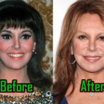 Marlo Thomas Plastic Surgery, Before After