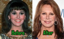 Marlo Thomas Plastic Surgery, Before After