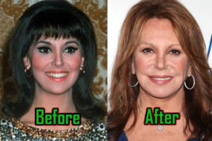 Marlo Thomas: Extreme Plastic Surgery Struck Her Face, Before After!