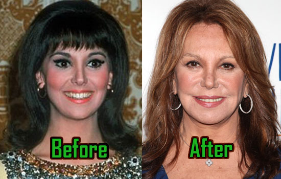 Marlo Thomas Plastic Surgery, Before After