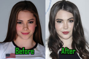 McKayla Maroney Plastic Surgery, Butt Implant Rumor, Before After