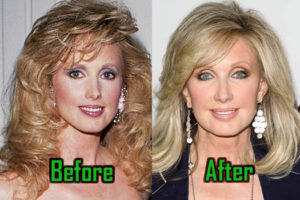 Morgan Fairchild Plastic Surgery: Facelift, Botox, Before After!
