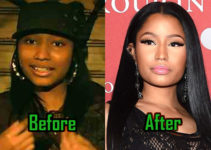Nicki Minaj Plastic Surgery Photo