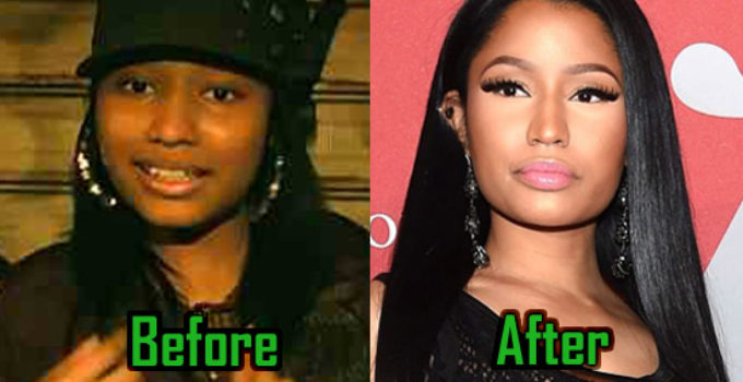 Nicki Minaj Plastic Surgery Photo