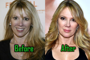 Ramona Singer Plastic Surgery: Facelift Keeps Her Young Face? Before-After!