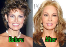 Raquel Welch Plastic Surgery: Facelift, Boob Job, Before-After Photos
