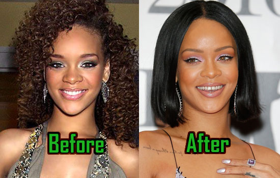 Rihanna Plastic Surgery Photo