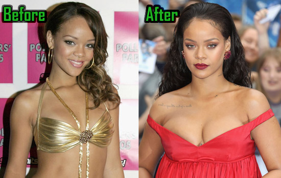 Rihanna Surgery, Boob Job Photo.