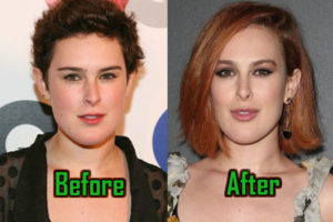 Rumer Willis Plastic Surgery Reduced Her Jaw? Before-After!