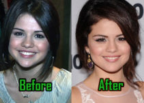 Selena Gomez: Plastic Surgery on Nose and Lips? Before-After!