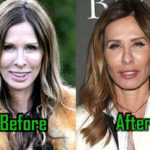 carole Radziwill Plastic Surgery Photo