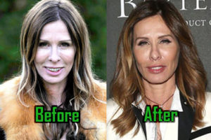 Carole Radziwill: Plastic Surgery Behind Her Ever-Changing Look?