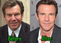 Dennis Quaid Plastic Surgery: Botox and Eye Lift? Before-After Photos!