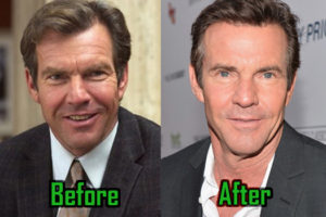 Dennis Quaid Plastic Surgery: Botox and Eye Lift? Before-After Photos!