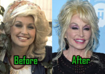 Dolly Parton Plastic Surgery