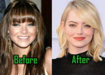 Emma Stone Plastic Surgery: Nose and Lips Job? Before-After Photos!