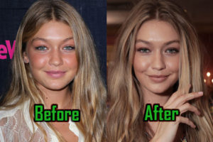 Gigi Hadid Plastic Surgery: Did She Have Nose Job? Before-After!