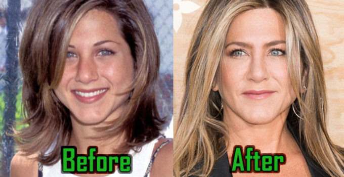Jennifer Aniston Plastic Surgery