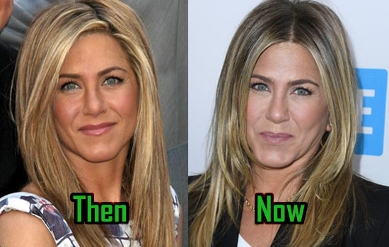 Jennifer Aniston Surgery, Botox