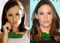 Jennifer Garner Plastic Surgery: Lips Injection, Nose Job, Before After Photos!