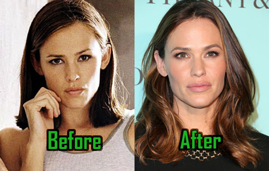 Jennifer Garner Plastic Lips Injection, Nose Job, After Photos! - CelebritySurgeryIcon