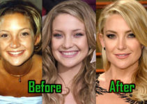 Kate Hudson Plastic Surgery: Boob Job, Nose Job! Before After Photos!