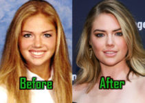 Kate Upton: Plastic Surgery for Boobs and Nose? Before After!