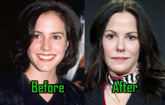 Mary Louise Parker Plastic Surgery