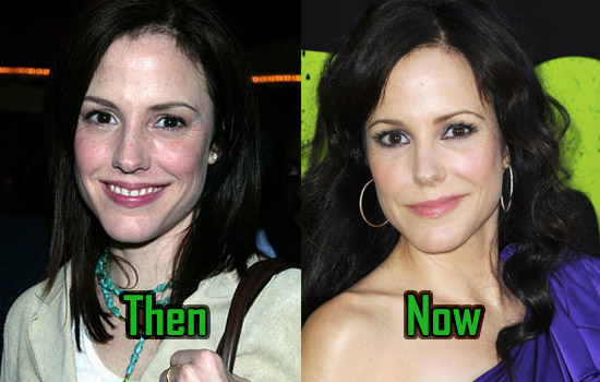 Mary Louise Parker Surgery, Nose Job. 