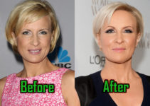 Mika Brzezinski: Plastic Surgery for Facelift? Before-After!