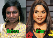 Mindy Kaling: Plastic Surgery Enhances Her Nose and Lips? Before After!