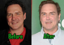 Norm Macdonald Plastic Surgery: Facelift, Botox, Before After Photos!