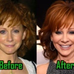 Reba McEntire Plastic Surgery