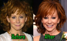 Reba McEntire Plastic Surgery