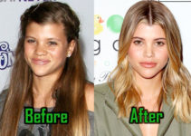 Sofia Richie Plastic Surgery, Before and After
