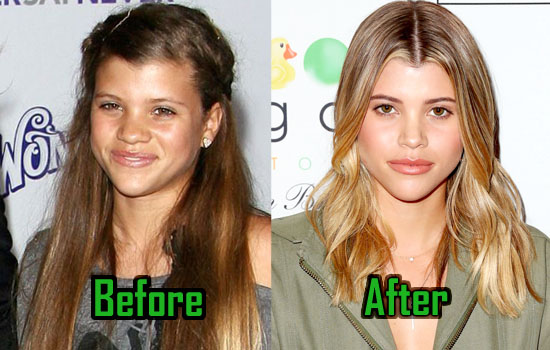 Sofia Richie Plastic Surgery, Before and After