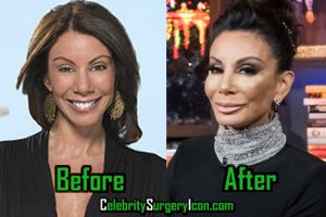 Danielle Staub Plastic Surgery, Boob Job, Before and After!