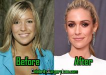 Kristin Cavallari Plastic Surgery, Before and After