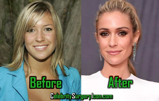 Kristin Cavallari Plastic Surgery, Botox, Before and After