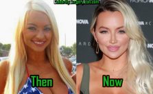 Lindsey Pelas Before and After Surgery Picture