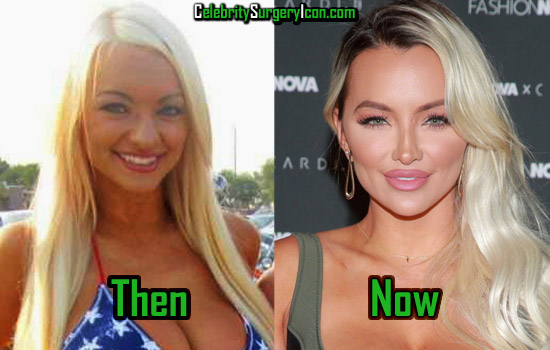 Lindsey Pelas Before and After Surgery Picture