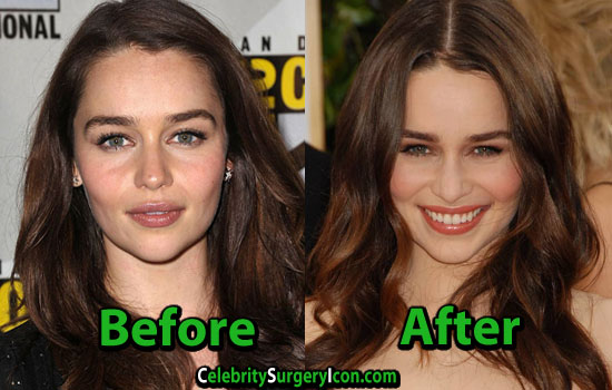 Emilia Clarke Plastic Surgery