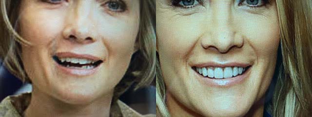 Dana Perino Before and After Teeth Surgery