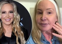 Shannon Beador’s Plastic Surgery Journey: The Truth Behind Fillers