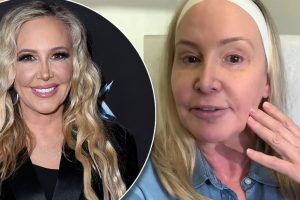 Shannon Beador’s Plastic Surgery Journey: The Truth Behind Fillers