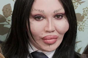 Pete Burns’ Journey Through Plastic Surgery: Nose Jobs and Lip Augmentation